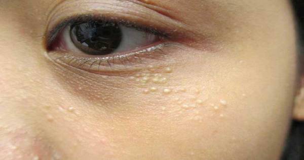 Cómo eliminar milium o Milia, esas bolitas blancas que salen en la cara, alrededor de los ojos, y en otras partes del cuerpo.